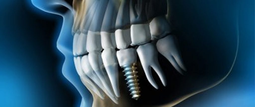 Implantologie Dentaire