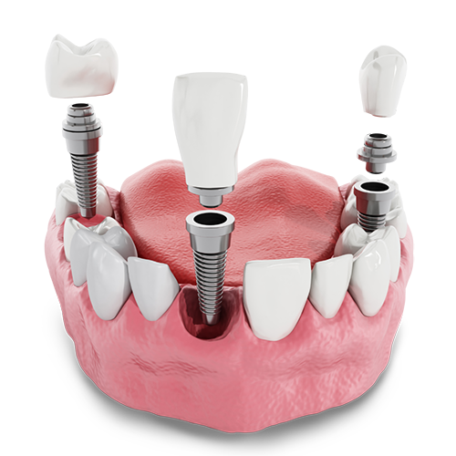 Implantologie Dentaire